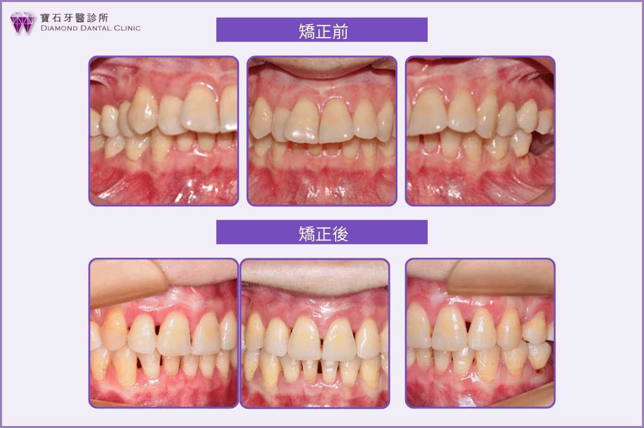 牙齒矯正案例